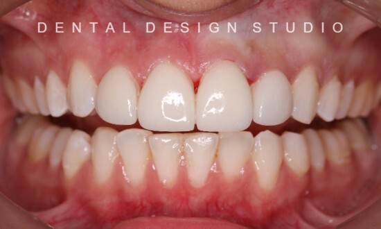 dentist in cancun before and after